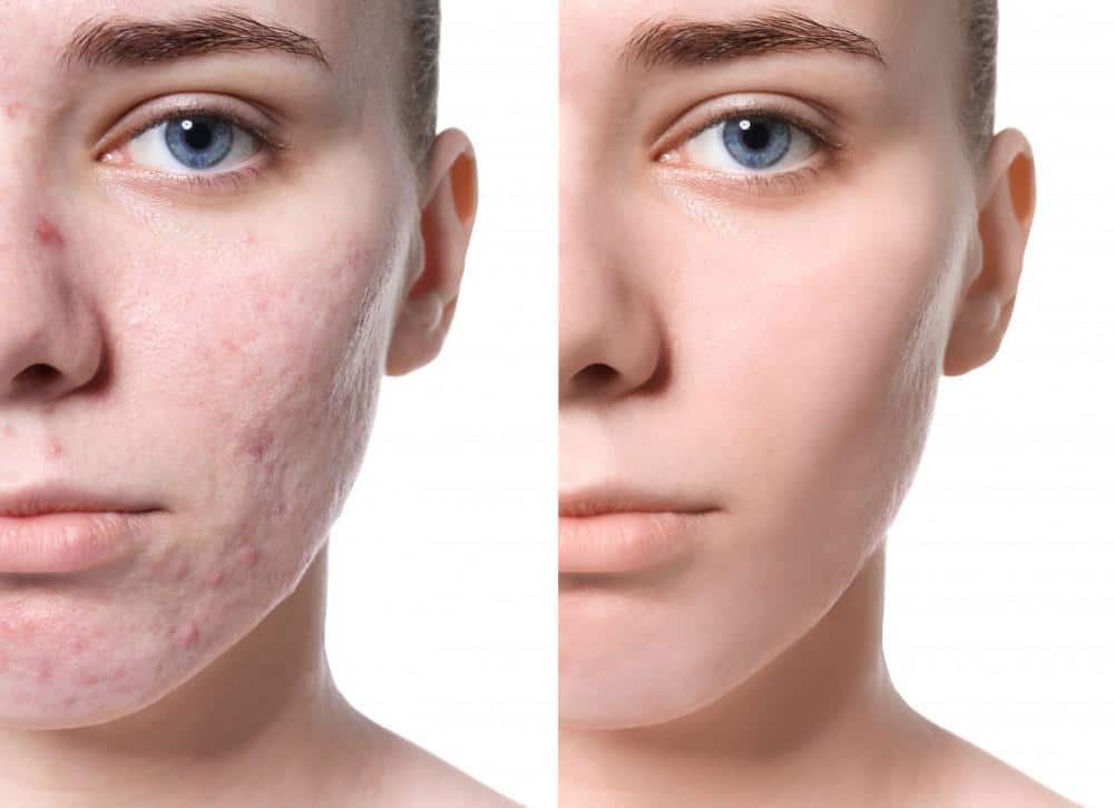 How Can I Get Rid Of Acne Scars Lake Jackson Ent Blog 0205