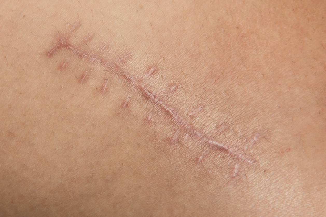 Close up of a scar